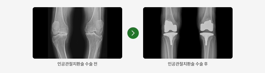 인공관절치환술 수술 전, 후