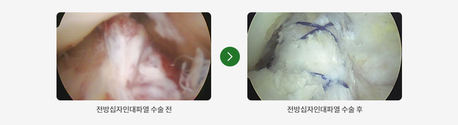 전방십자인대파열 수술 전, 후