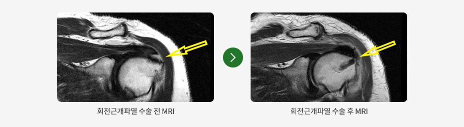 회전근개파열 수술 전, 후 X-ray