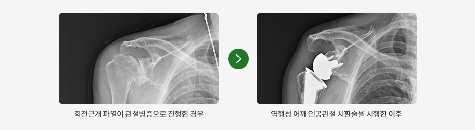 회전근개파열 수술 전, 후 X-ray