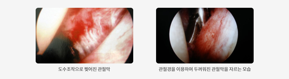 왼쪽부터 도수조작으로 찢어진 관절막, 관절경을 이용하여 두꺼워진 관절막을 자르는 모습